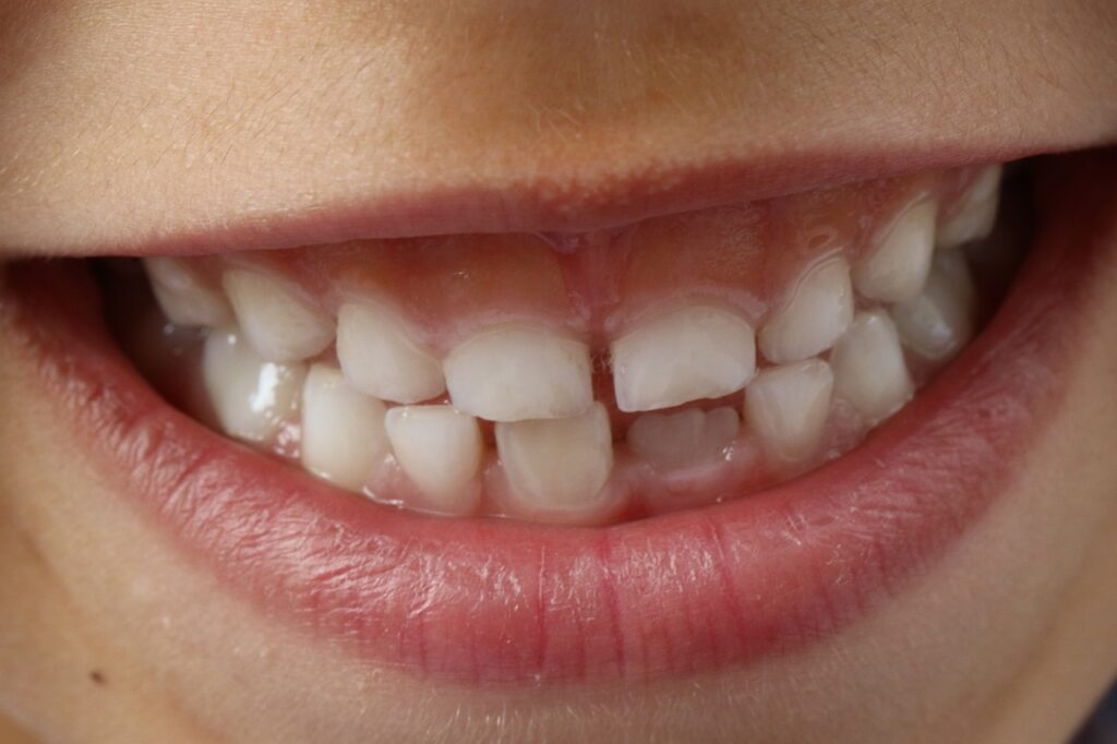 Фторирование зубов: почему показано детям